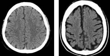 医学病理学视角：眼距宽的生理成因与智力发育的关联性