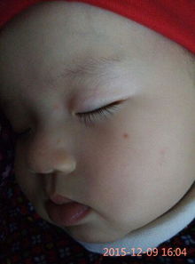 一、 儿童痣的临床特征及演变规律