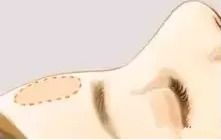 非手术方法：微创塑美的可行路径