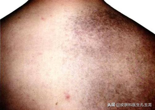 2. 黑色痣与交际受限之警示