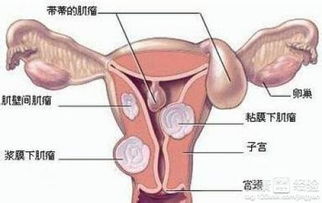 1. 阴道不规律出血：最常见的“敲门风”