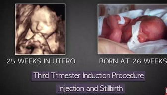 3. 子宫穿孔与感染风险的叠加效应