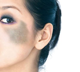 太田痣、伊藤痣与蓝痣