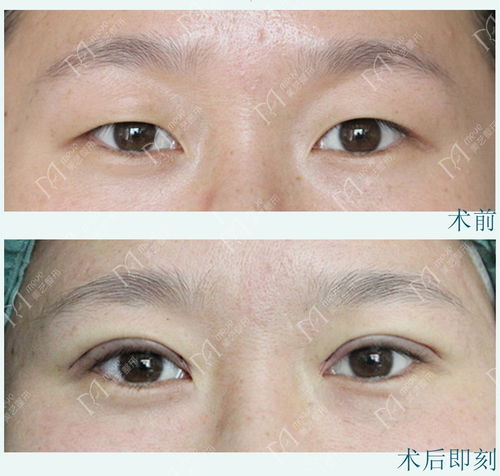 左右眼兆吉凶，左右眼睛大小眼怎么办？如何改善？