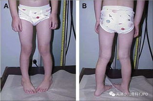 如何纠正孩子走路时一个腿外八字的问题？