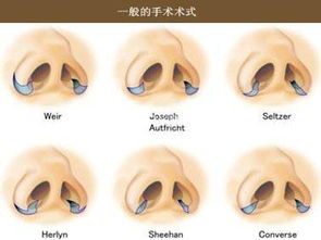 二、 鼻翼区域的解剖学特征及其对手术设计的作用于