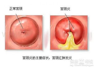 宫颈炎医治的禁忌，你了解更多更少个？