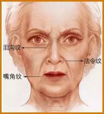 二、 “法令纹”与“嘴角纹”的定义差异