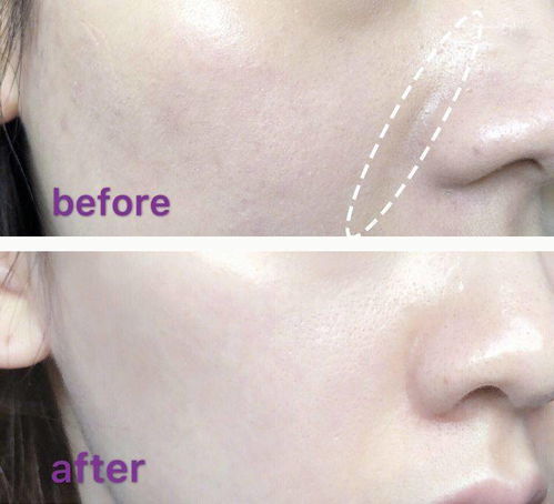 嘴角八字纹命运如何，如何消除嘴角两侧的纹路？