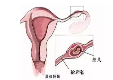 2．终止妊娠对子宫功能及生育潜能的有可能作用于