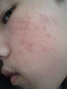 为什么有些人既是过敏体质又是疤痕体质？