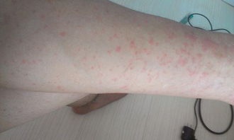 八字土弱的人容易患哪种皮肤病？八字土重的人又容易得什么病？