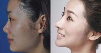 鼻梁塌陷是否意味着风水不佳，有什么影响？