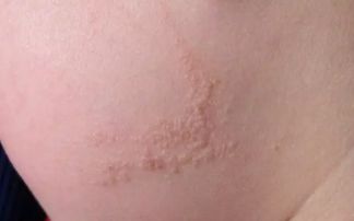 面部胎记：社会关注焦点与个体身份标签