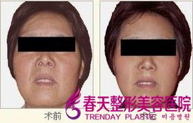 一、  激光技术与射频治疗