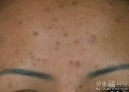 巨型黑素细胞痣：由浅入深的渐进发展