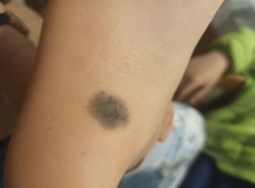 恶性转化的典型表现及其判别标准