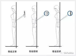 哪些是盆骨前倾？