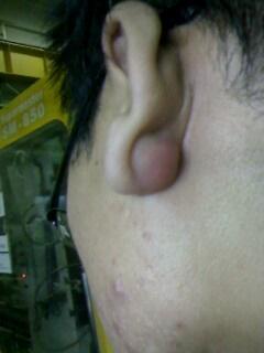 左右耳垂痣点位置差异及其对应寓意