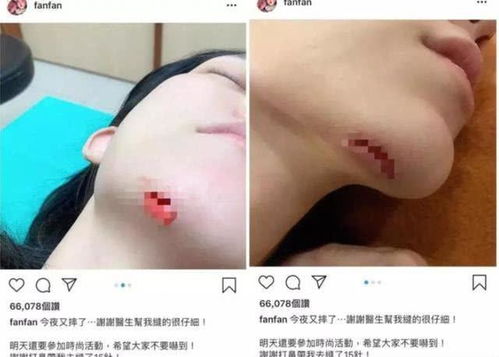 梦见自己下巴缝针是什么预兆或暗示？