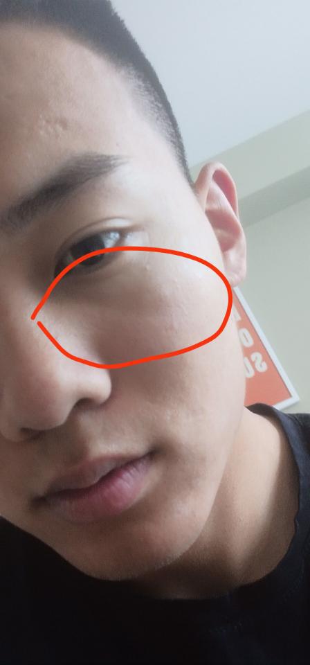 眼睛下方八字纹如何有效消除或改善？