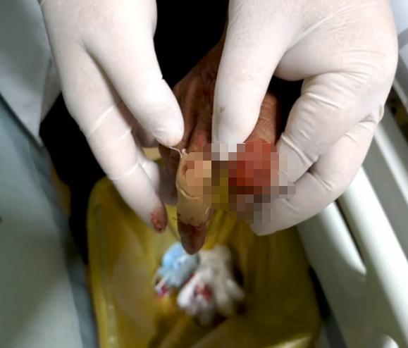 梦见手指被蛇咬伤有什么特殊预兆或含义？