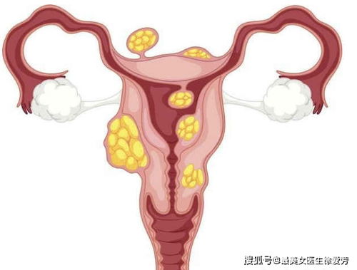 ：子宫肌瘤患者饮食管理的学术概述