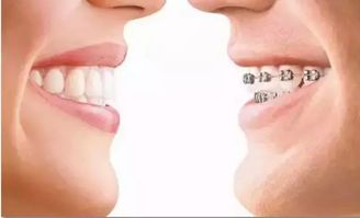 2. “缺牙”导致的面部塌陷与“老态”预兆