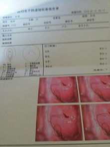 2. 宫颈及子宫腔粘连的形成机制