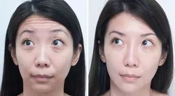 打除皱针会对家居风水产生哪些不利影响呢？