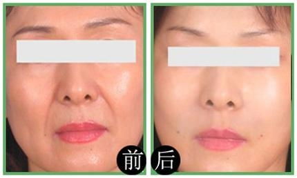 1. 肉毒素注射的神经肌肉阻断机制