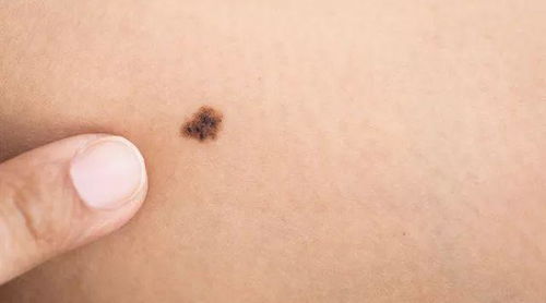 胎记与痣的区别及共同之处