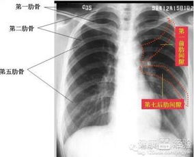 右侧肋骨上“腹澎痣”之定位、 特征及行为倾向