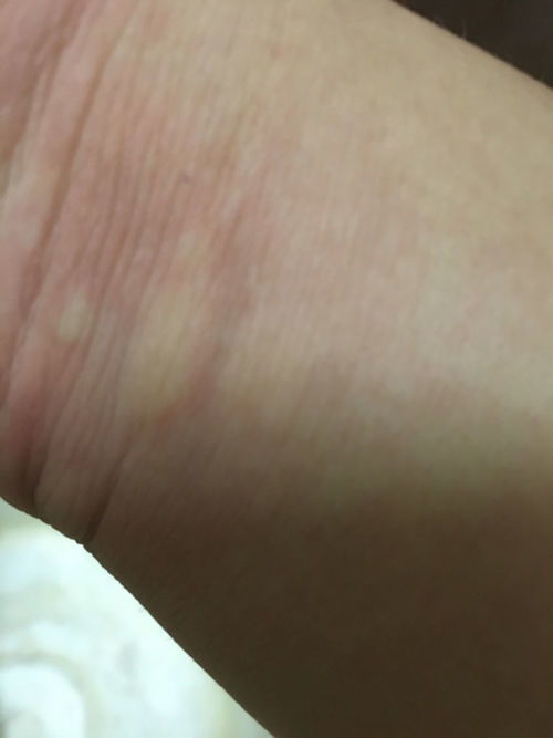 梦见被蚊子咬，这预示着什么吉凶？