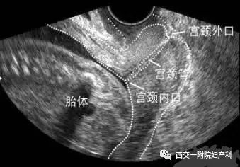 宫颈管较长度那一些事儿