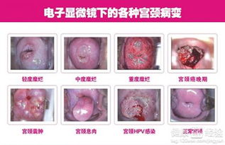 1. 宫颈糜烂或宫颈息肉