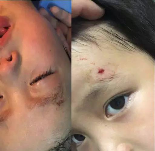 梦见别人额头有伤口是什么预兆或象征？