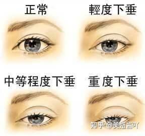 二、 半睡眼（上睑下垂）