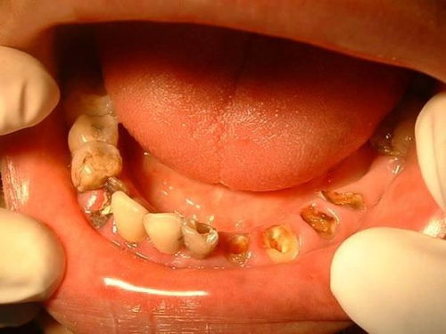 女人梦见自己用手拔掉蛀牙是什么征兆或含义？