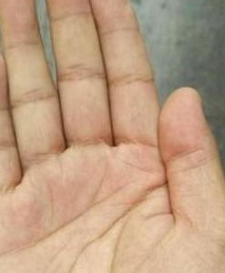 十、 风湿病在手相上的特征