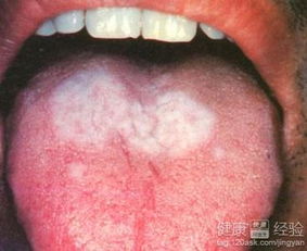 3. 白厚滑苔：瘀湿内生的征兆