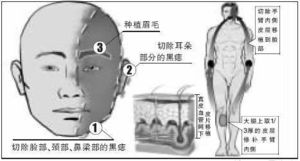 2. 外伤与炎症刺激