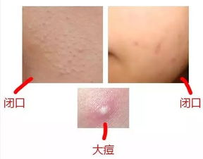 统计性指标：易长痘痘者之出生要素汇总