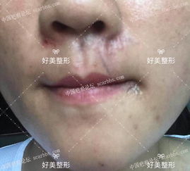 三、 嘴巴和鼻子疤痕：财运损耗与爱情波折