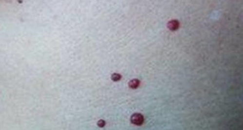 四、基底层生理机制：色素生成与角质梗新