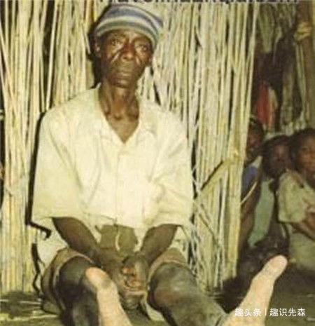 非洲双趾族及其生理状况特征
