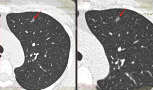 3．肺结节切除手术