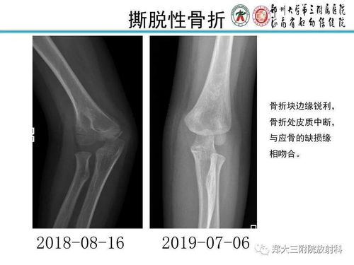 1. X线平片：迅速筛查但分辨率有限