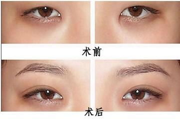 三、细分人群：不同情况下的手术选择