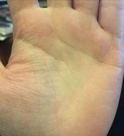 3. 较大腿痣：潜藏的财富有密码